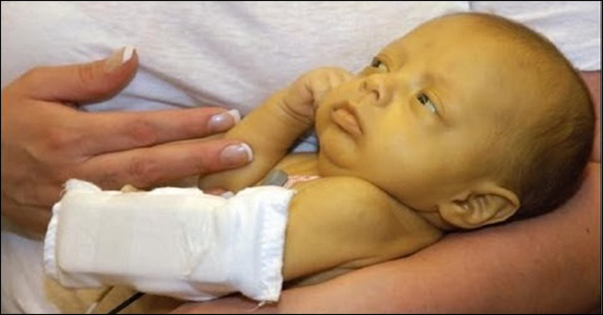 New Moms Guide To Newborn Jaundice Baby Turning Yellow