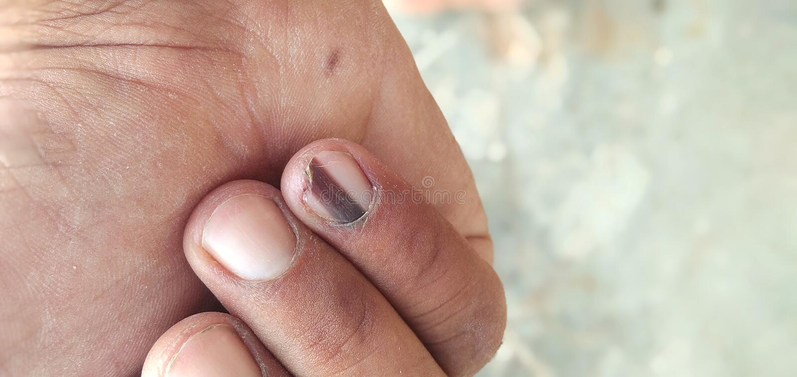 Black Line on Nails. Subungual Melanoma. Stock Image - Image of melanoma,  black: 191856093