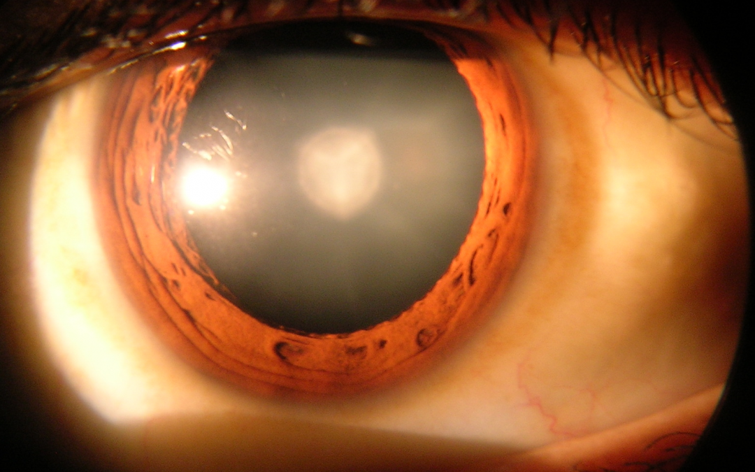 Slit lamp examination of a patient with early stage immature cataract